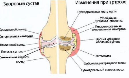 normalosteoarthritis0