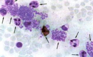 Сегмснтно-ядерныс лейкоциты с набухшими от токсинов ядрами, погибая, но атакуя трихомонад, заставили их гранулироватьcя до «тромбоцитов». Цистоподобная трихомонада (внизу слева). Kycoчек холестерина (в центре), попавший из печени в кровь.