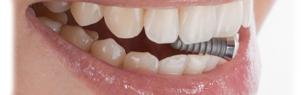 Современная имплантация зубов - миф или реальность. Зубы из титана 