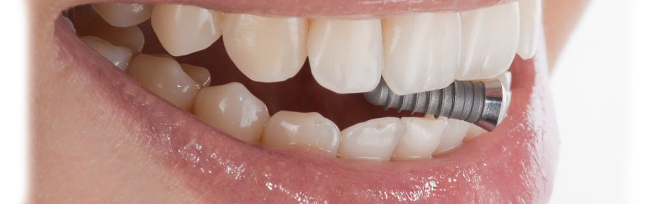 Современная имплантация зубов - миф или реальность. Зубы из титана